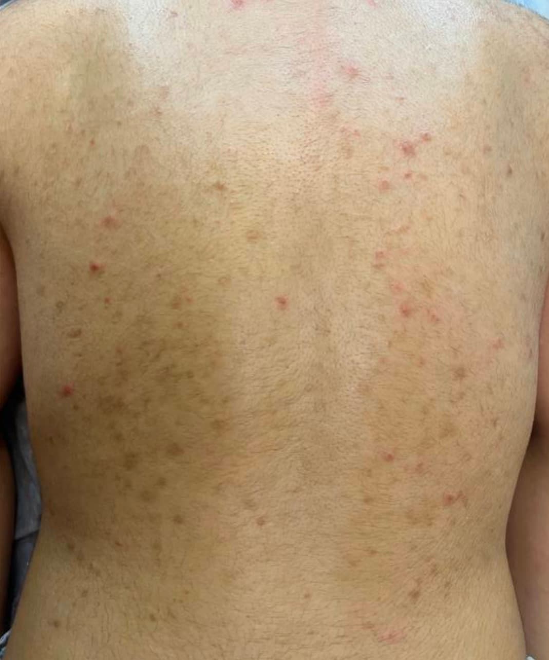 نتیجه یک جلسه فیشال بدن — قبل